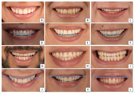 Lip Smiling