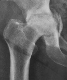Biologic technique achieves good outcomes in patients with acetabular ...