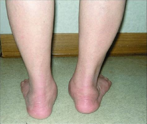 toes sign wikism sports medicine wiki