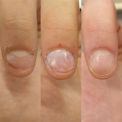 Will My Nail Grow Back After Removal at Edward Meyers blog