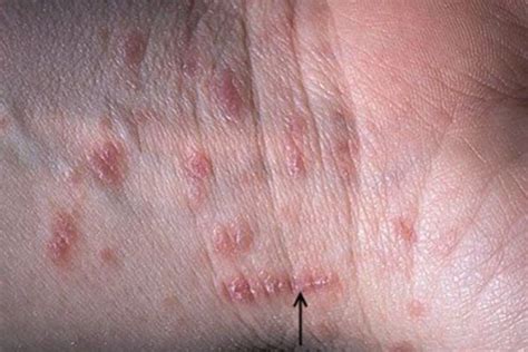 Comment traiter la gale?