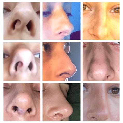 Before and after two nose surgeries : r/PlasticSurgery