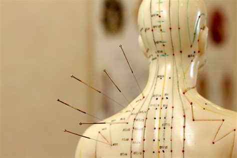 akupunktur nach traditioneller chinesischer medizin