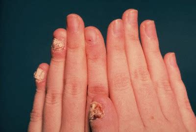 healthy  beauty tips   cure nail fungus nail fungus treatment