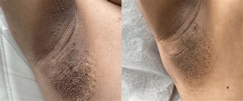 skin tags chicago skin clinic