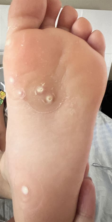 Child dealing with plantar warts : r/Warts