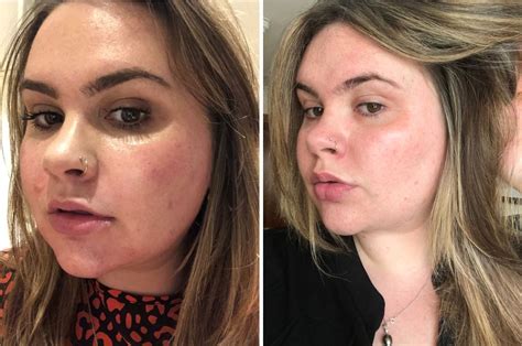 Hyaluronic Acid Serum Before And After Photos