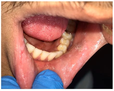 Leukoplakia Cheek Bite
