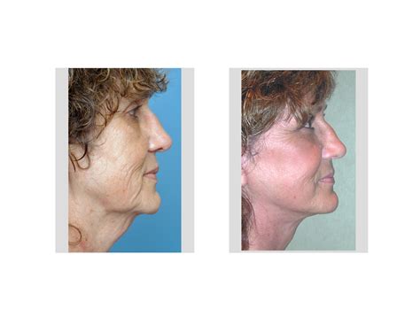 facelift-rejuvenation-indianapolis-dr-barry-eppley - Explore Plastic