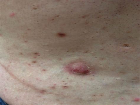 Tunnels Hidradenitis Suppurativa at Chelsea Frome blog