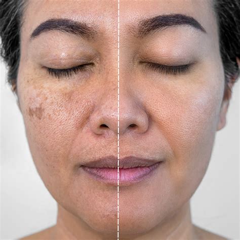 brown spot treatment beauty