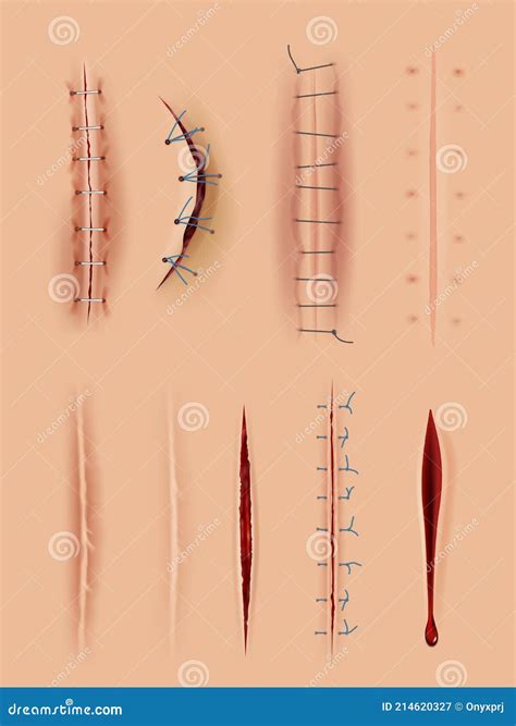 Realistic Scars. Medical Surgical Sutures Wounds Close Up Pictures on