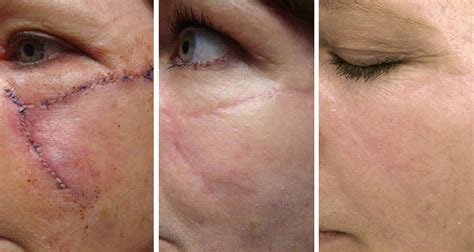 scar revision  sciton profractional laser  medford  pure medspa