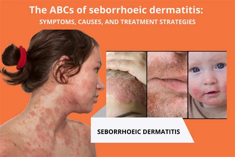 seborrheic dermatitis  comprehensive guide