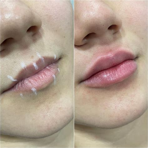 Preenchimento Grandes Lábios Antes E Depois - Injecoes Labiais Antes E Depois Do Juvederm Preenchimento De Nariz