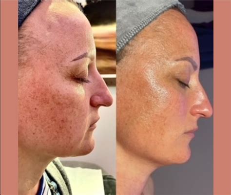 Before & After Gallery – Cincinnati NeoGen Plasma Skin Regeneration