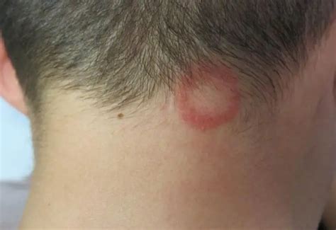 how to know if you have ringworm on your scalp