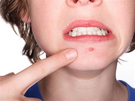 Espinhas No Queixo O Que Pode Ser - Como se livrar das espinhas no queixo - 6 passos