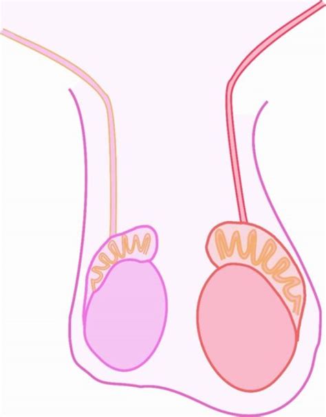 Epididymo-orchitis: clinical features - FRCEM, MRCEM, Ultrasound Emergency Medicine Courses