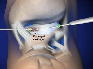 Ankle Arthroscopy: Surgical Treatment of Osteoarthritis in the Ankle ...