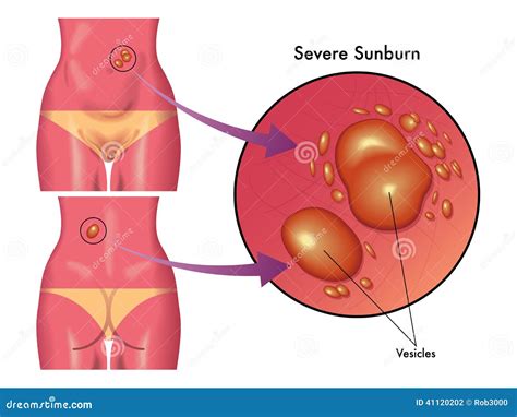 Severe sunburn stock vector. Illustration of papules - 41120202