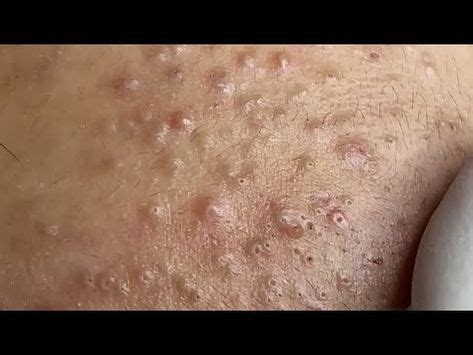blackheads on nose in 2025