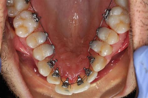 lingual braces fulham london social  lingual brace cost