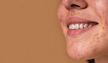 acne  treatment     rid