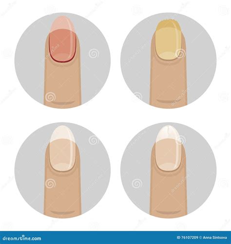 Vector icons nail diseases stock vector. Illustration of body - 76107209