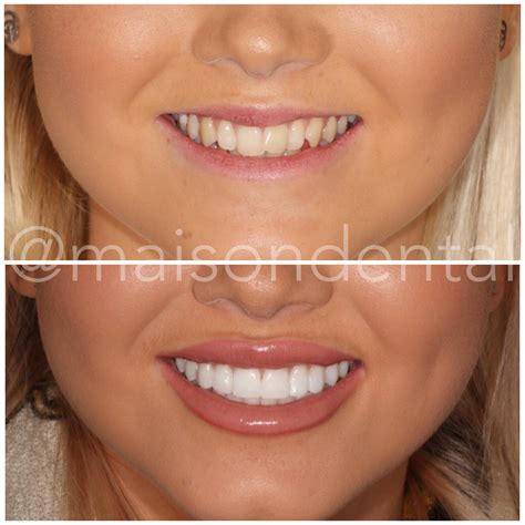 Correcting overlapping front teeth - Maison Dental