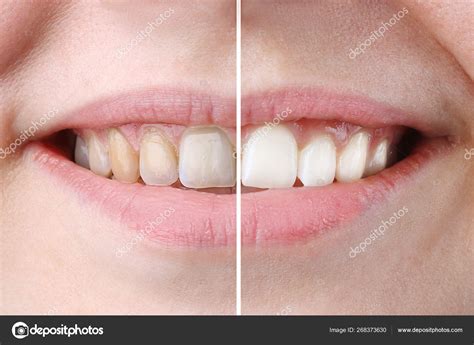 Whitening or bleaching treatment ,before and after ,woman teeth and ...