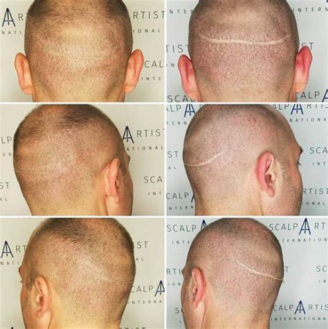 Scalp Micropigmentation For Scars - Scalp Artist International