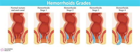 Hemorrhoids, Causes, Symptoms And Treatment!