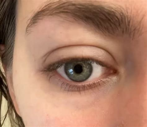 undereye muscle spasm rmedicaladvice