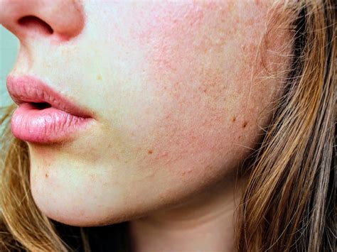 Vitamin D deficiency: Watch out for this major sign on your skin