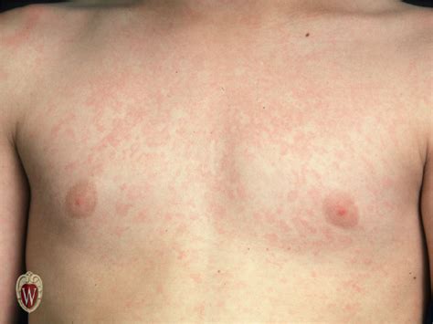 Tutorial A: The Primary Lesions – Department of Pediatrics – UW–Madison