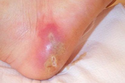 Abscess-Boil: Symptoms and Treatment | Dermatology of Southeastern Ohio