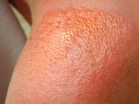 Blisters On Face Treatment - Doctor Heck