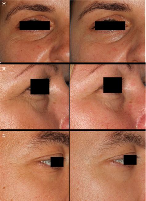 Effects of a series of carboxytherapy treatments; photos were made... | Download Scientific Diagram