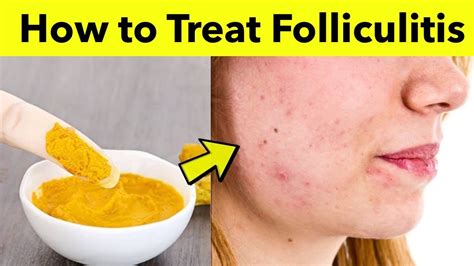 Scalp Folliculitis Cure And Treatment - vrogue.co