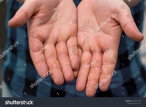 dyshidrotic eczema hands patient concept health stock photo edit