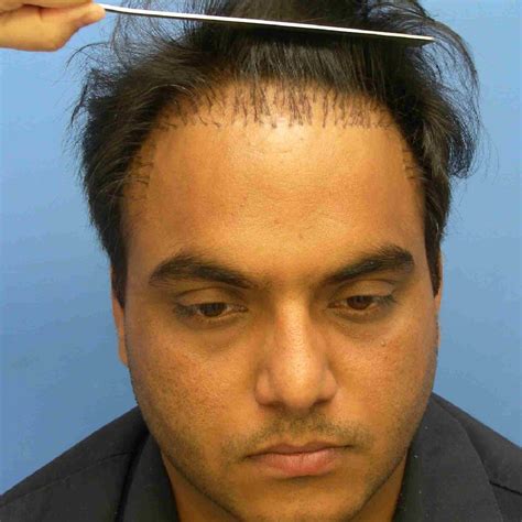 Hair Plugs Versus A Modern Hair Transplant