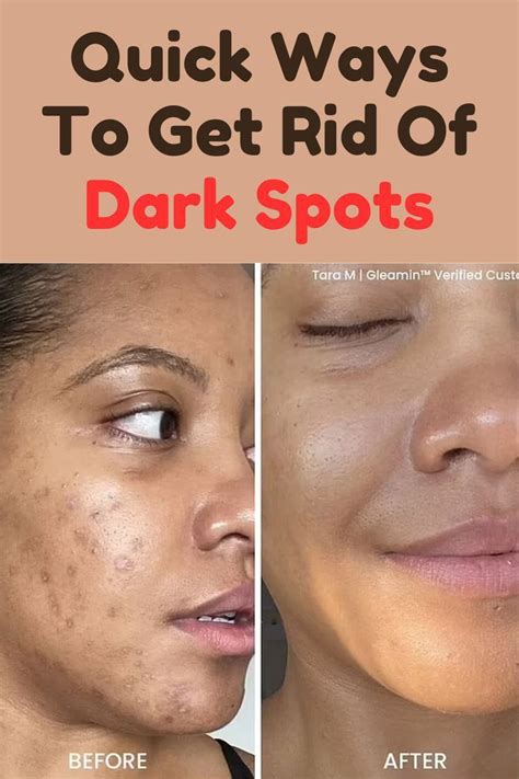 How To Get Rid Of Darkspots Naturally