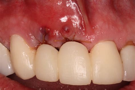 medical cpt code  dental bone graft  kenneth thomas blog