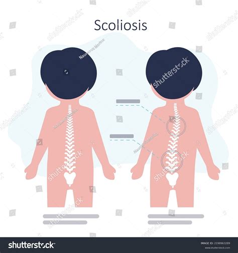 Scoliosis Kids: Over 99 Royalty-Free Licensable Stock Vectors & Vector