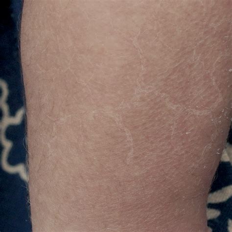 mengatasi kulit bayi kering