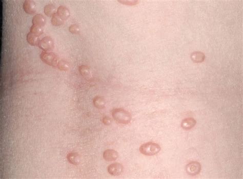 molluscum contagiosum  genital warts
