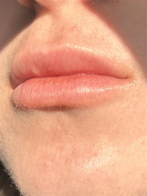 White bump after lip filler : r/PlasticSurgery