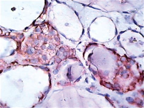 Case 2: C cells showing positive chromogranin, but without the presence ...