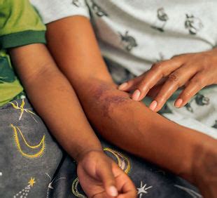 Bruising due to leukaemia | Know the signs to look for